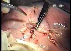 Ooforectomía laparoscópica presentando las tijeras HARMONIC ACE®+7 con  hemostasia avanzada 